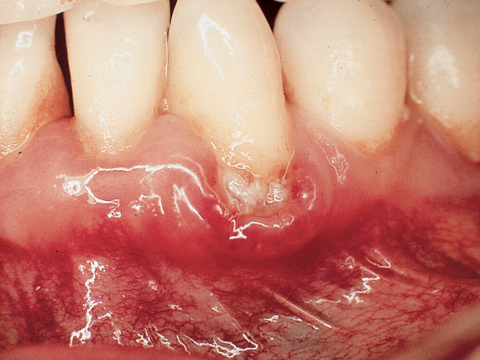 Photo of teeth and gum showing gum disease