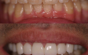 Before and after images showing dental restoration with CEREC technology, transforming discolored and uneven teeth into a bright, even smile.