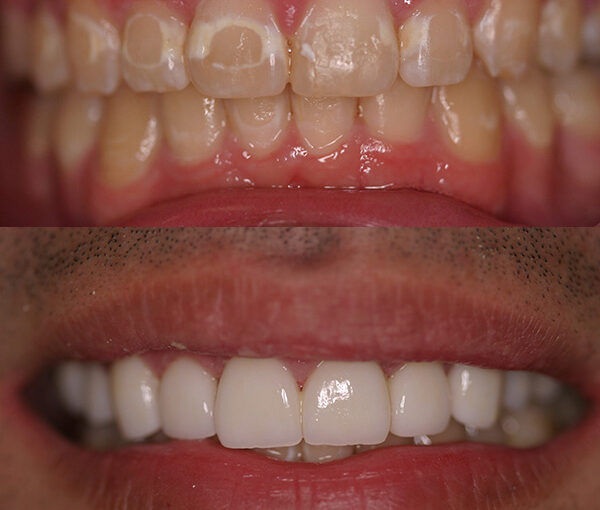 Before and after images showing dental restoration with CEREC technology, transforming discolored and uneven teeth into a bright, even smile.