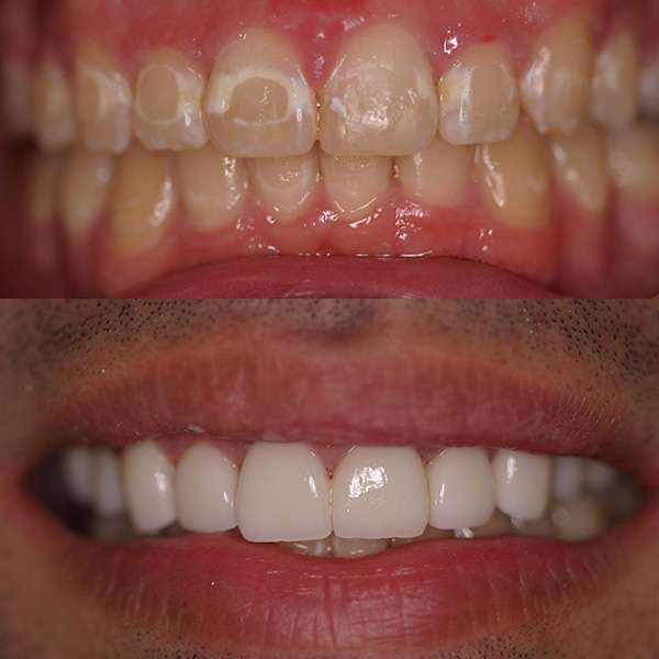 Before and after images showing dental restoration with CEREC technology, transforming discolored and uneven teeth into a bright, even smile.
